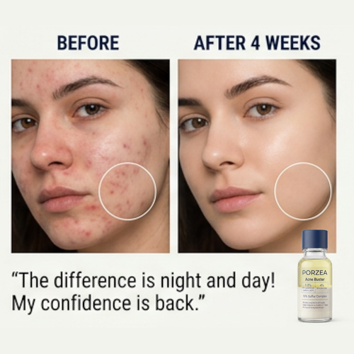 Porzea Pimple Treatment & Body Acne Treatment